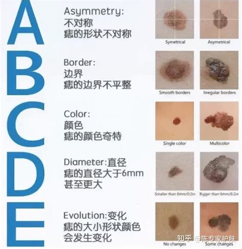 痣的顏色|痣有4種顏色，出現在「手腳這邊」的痣可能是皮膚。